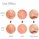 Kit Extractor de Espinillas - ClearSkin